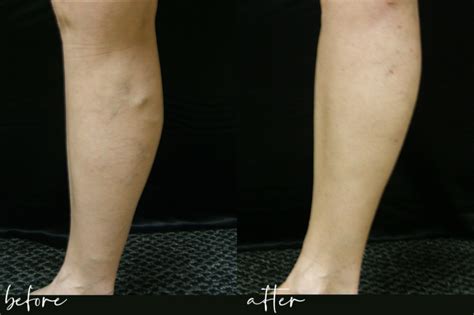Spider Vein Treatment Mt. Juliet .